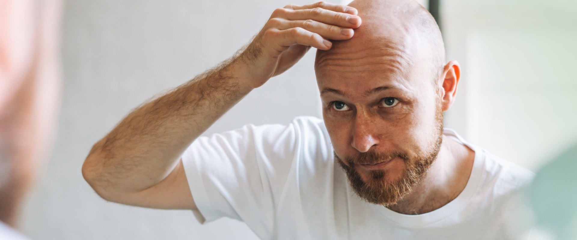 Exploring Lifestyle Factors and Male Pattern Baldness