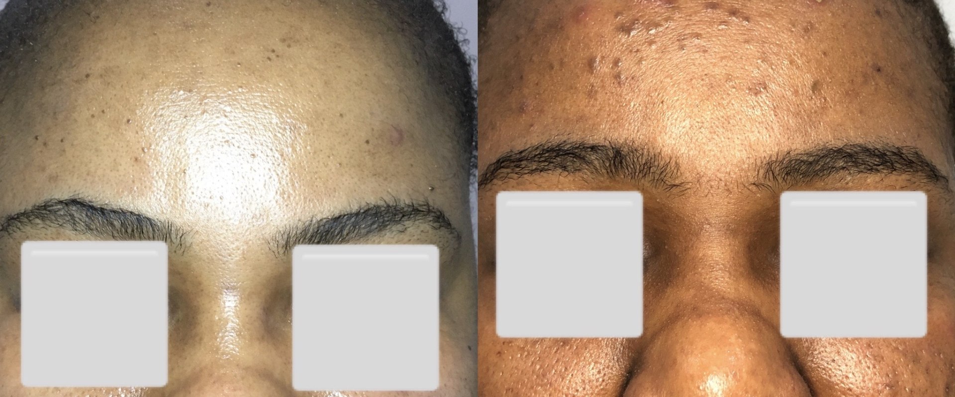 Understanding the Side Effects and Risks of Chemical Peels