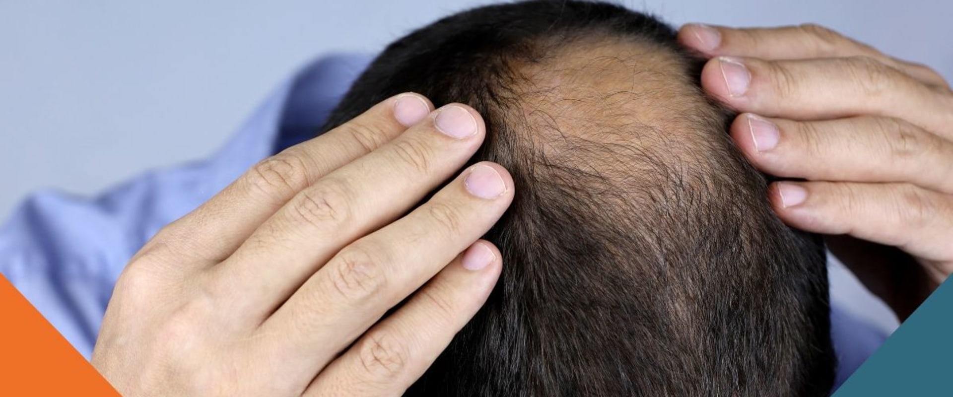 Hair Care Routine for Managing Male Pattern Baldness: Tips and Tricks