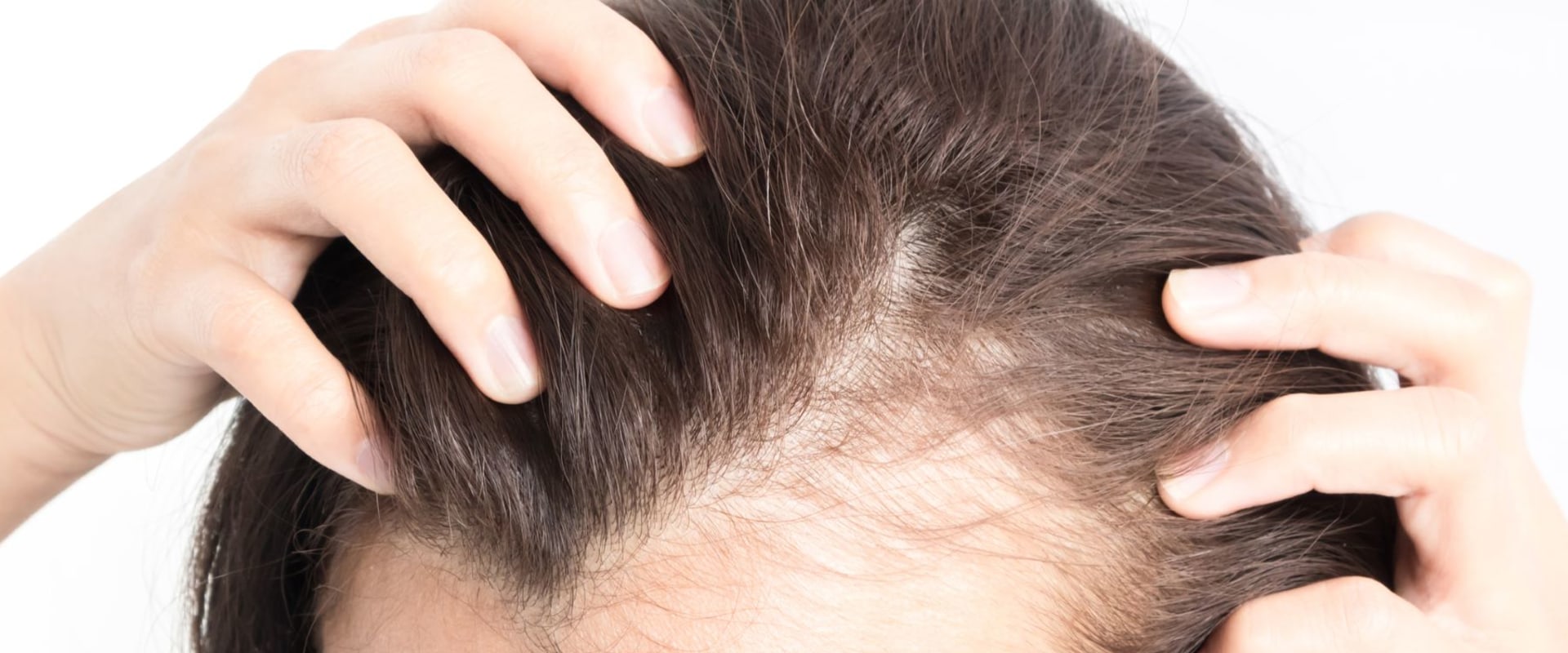 Understanding Female Hair Loss: Lifestyle Factors to Consider