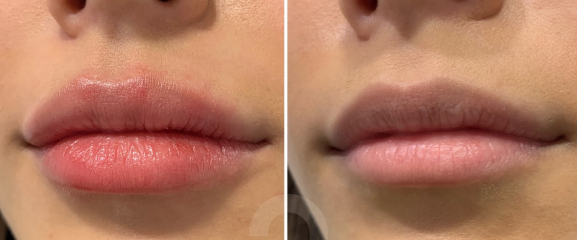 Benefits of Lip Fillers: Enhance Your Appearance with Cosmetic Injectables