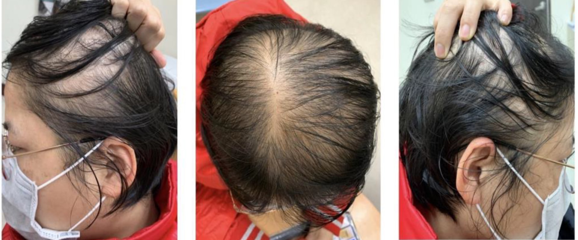 Diagnosing Female Hair Loss: A Comprehensive Guide to Understanding and Treating Hair Loss in Women