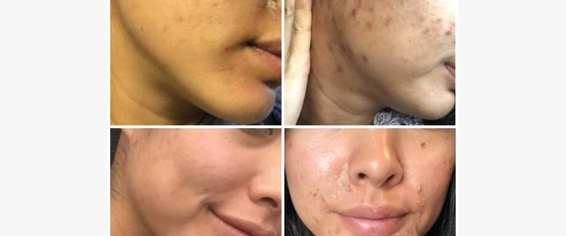 Understanding the Side Effects and Risks of Superficial Peels