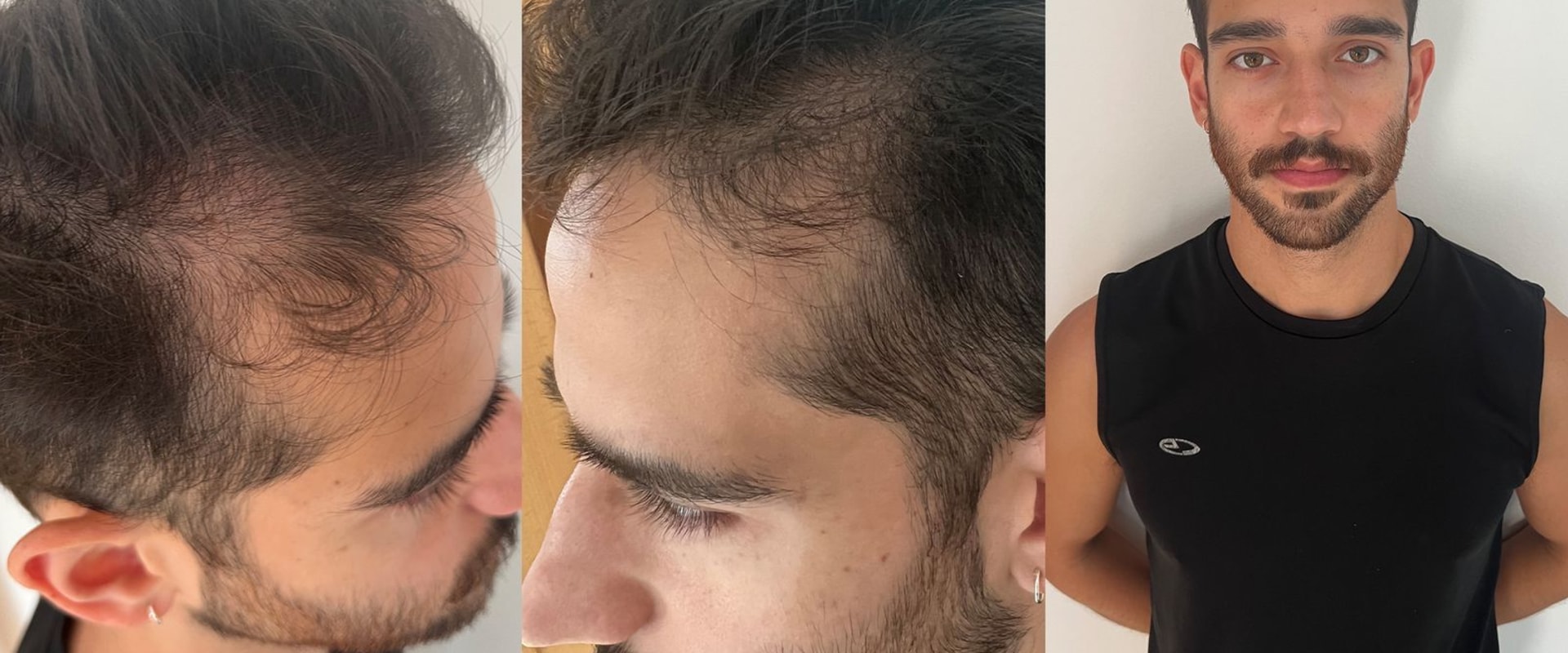 Understanding Hair Transplants