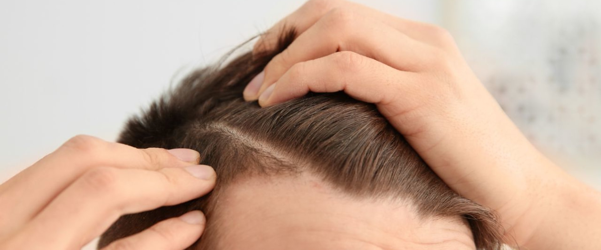 A Complete Guide to Finasteride: The Solution for Hair Loss