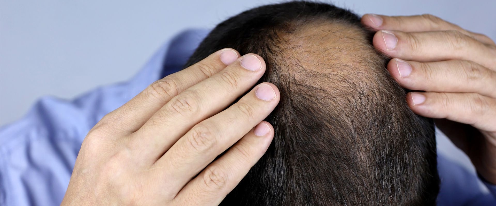 Understanding Minoxidil: A Guide to Hair Loss Treatments and Solutions