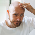 Exploring Lifestyle Factors and Male Pattern Baldness