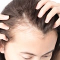 Understanding Female Hair Loss: Lifestyle Factors to Consider