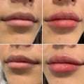 Benefits of Lip Fillers: Enhance Your Appearance with Cosmetic Injectables