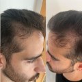 Understanding Hair Transplants