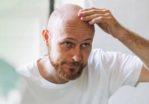 Exploring Lifestyle Factors and Male Pattern Baldness