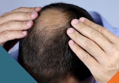 Hair Care Routine for Managing Male Pattern Baldness: Tips and Tricks