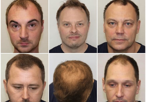 Understanding Male Pattern Baldness: Everything You Need to Know