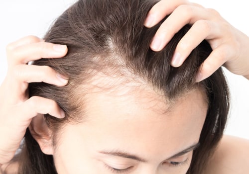 Understanding Female Hair Loss: Lifestyle Factors to Consider