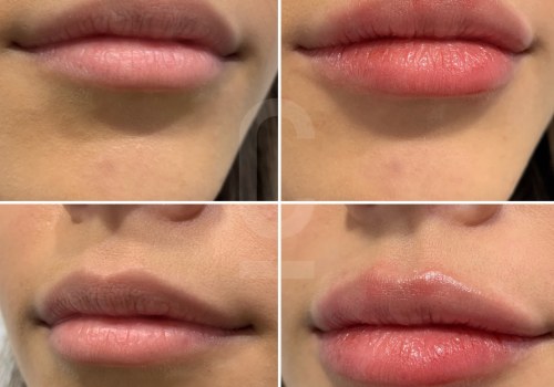 Benefits of Lip Fillers: Enhance Your Appearance with Cosmetic Injectables