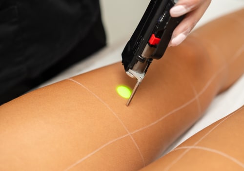 Types of Lasers Used for Hair Removal: A Comprehensive Guide