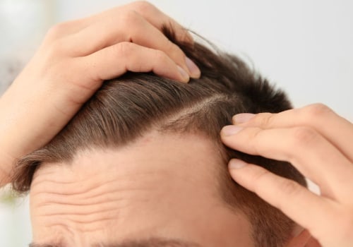 A Complete Guide to Finasteride: The Solution for Hair Loss