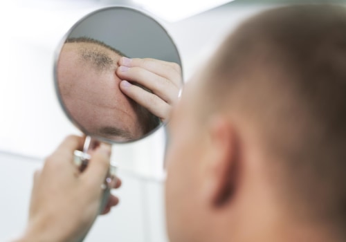 Understanding Genetics and Male Pattern Baldness