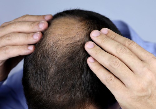 Understanding Minoxidil: A Guide to Hair Loss Treatments and Solutions